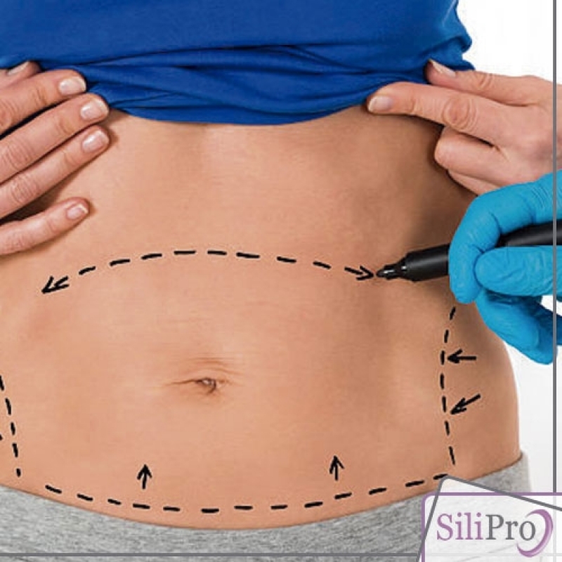 Abdominoplastia Afina a Cintura