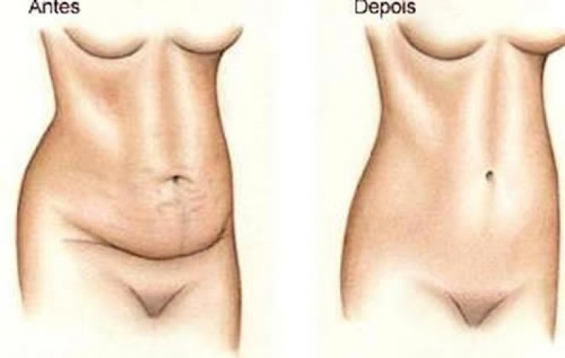 Abdominoplastia após Parto