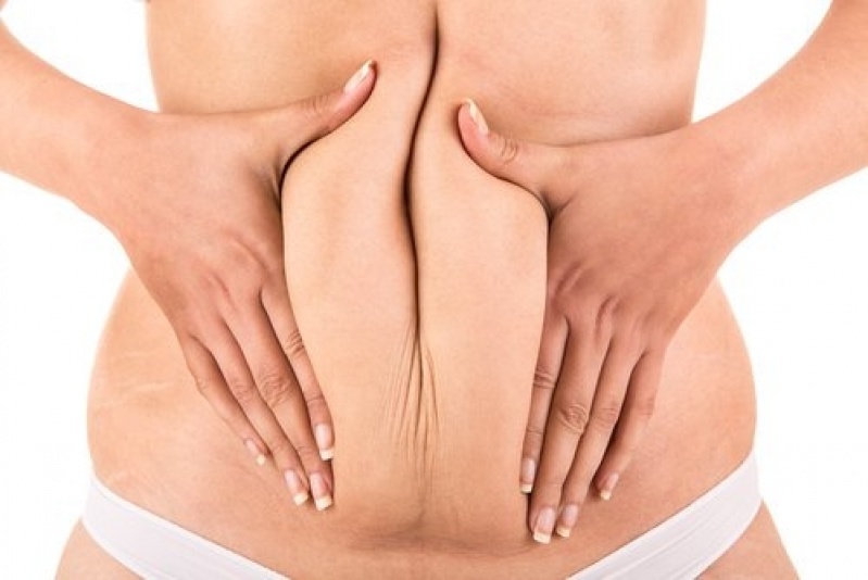 Abdominoplastia Completa