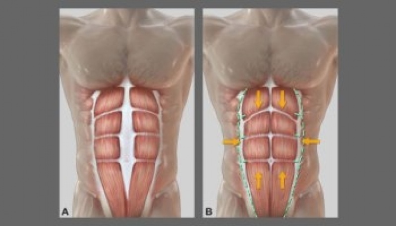 Abdominoplastia em Homem