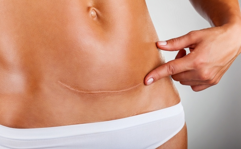 Abdominoplastia para Gordos