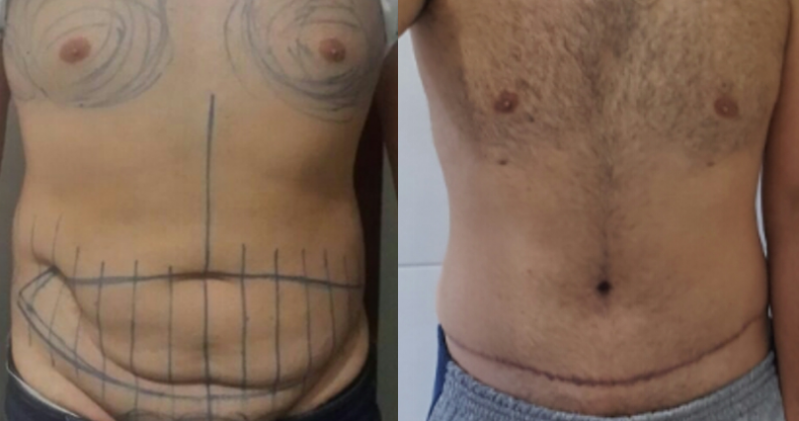 Abdominoplastia para Reduzir Medidas