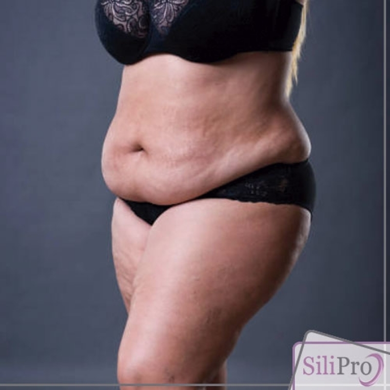 Abdominoplastia Pós Operatório