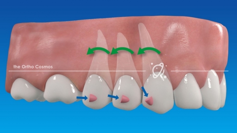 Aparelho Autoligado Invisalign