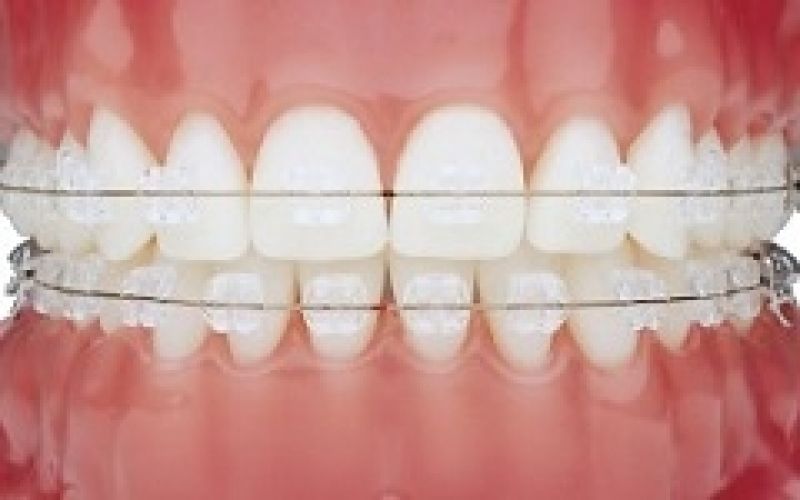 Aparelho de Dente