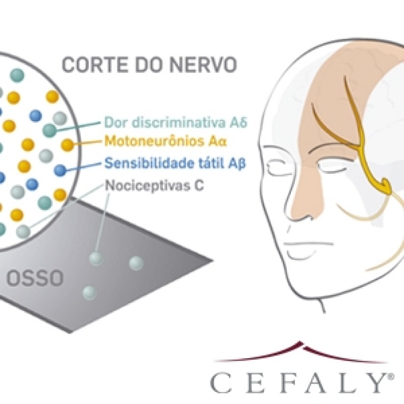 Aparelho de Neuromodulação para Enxaqueca Forte