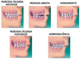 Aparelho Dentário Damon System