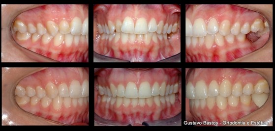 Aparelho Invisalign Ortodôntico