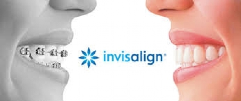 Aparelho Transparente Invisalign