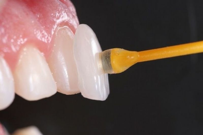 Aplicação de Lente de Contato Dental