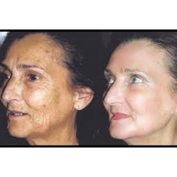 Aplicação de Peeling Químico