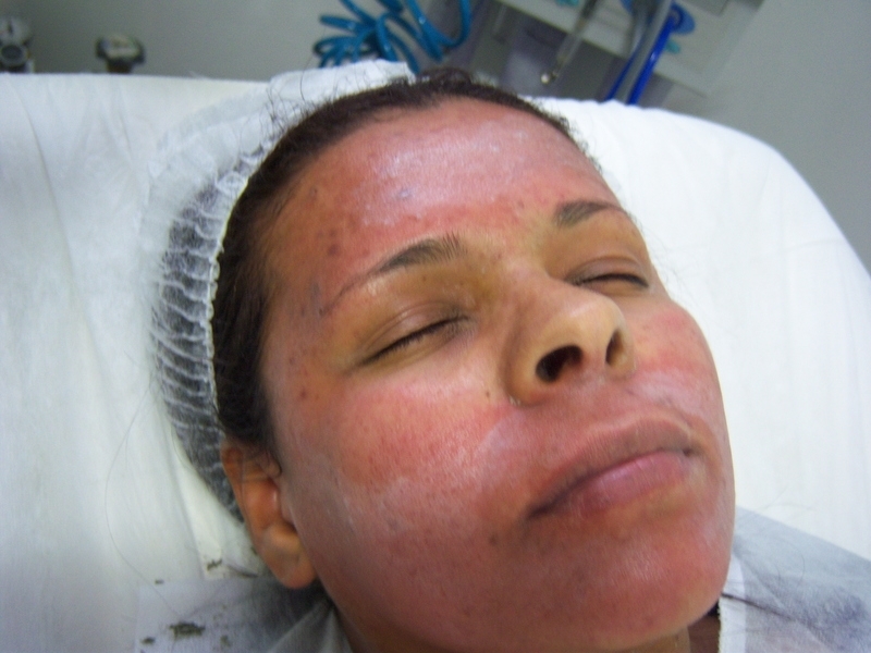 Aplicar Peeling Esfoliante Rosto