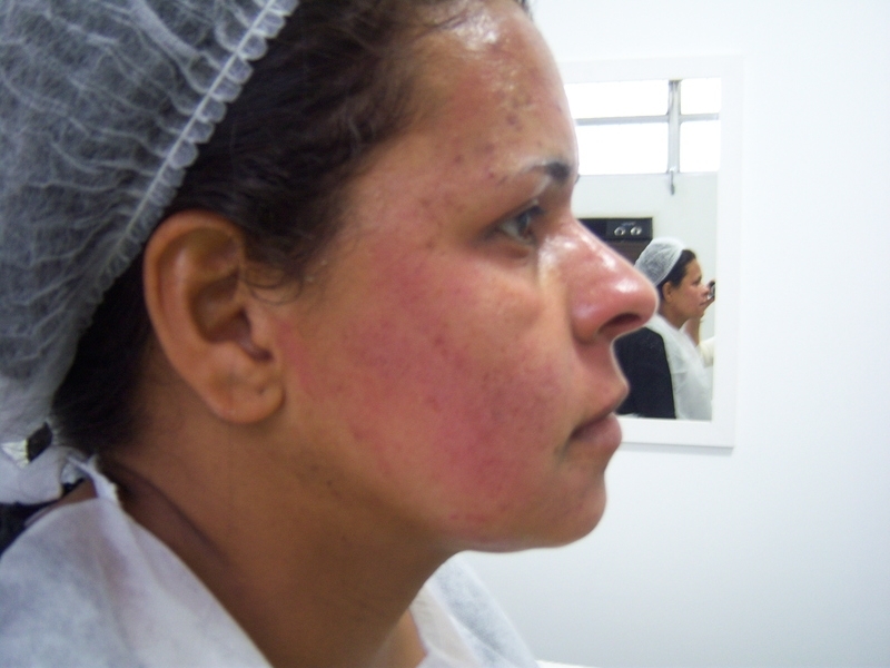 Aplicar Peeling no Rosto Acne