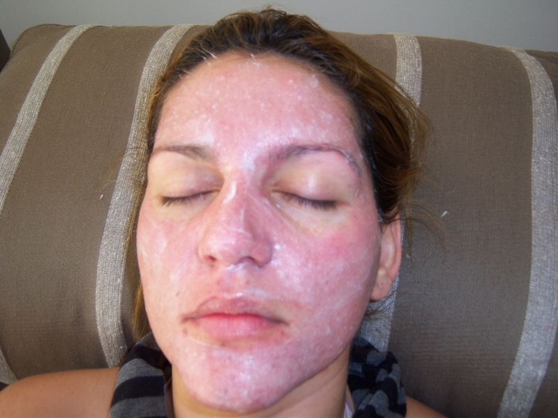 Aplicar Peeling para Rosto Oleoso