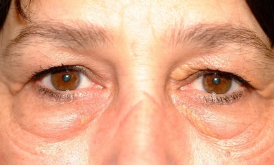 Blefaroplastia Cirurgia