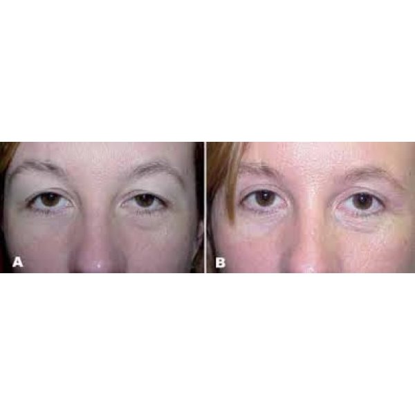 Blefaroplastia Estética