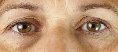 Blefaroplastia Inferior