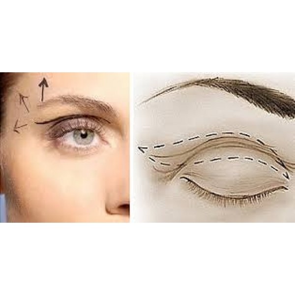 Blefaroplastia Laser
