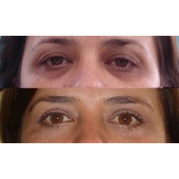 Blefaroplastia Superior