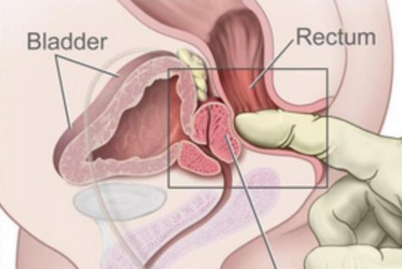 Cirurgia de Câncer de Próstata