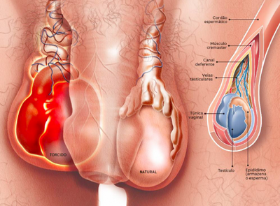 Cirurgia de Câncer de Testículo