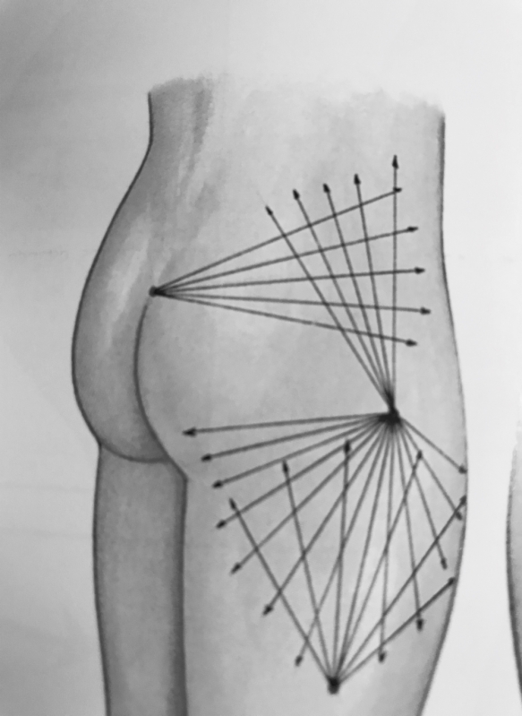 Cirurgia de Enxerto de Glúteo