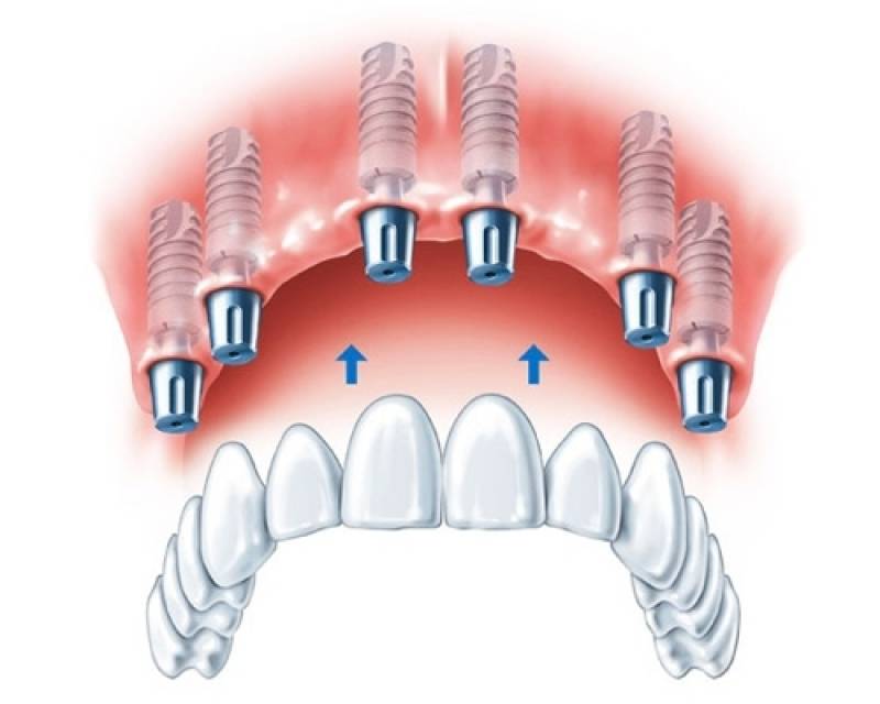Cirurgia de Implante Dentário