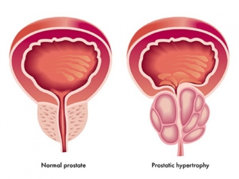 Cirurgia de Próstata a Laser