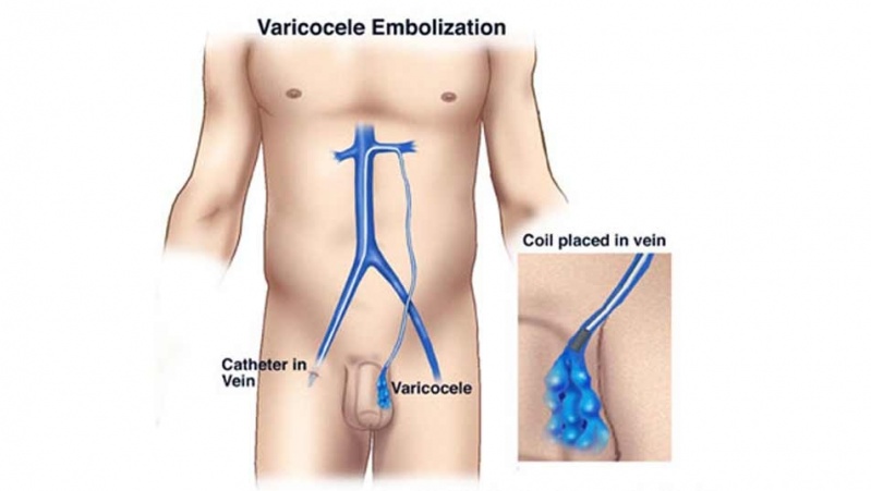 Cirurgia de Próstata pelo Canal