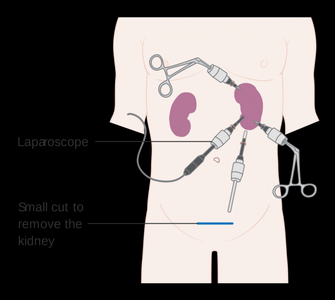 Cirurgia de Próstata Robótica