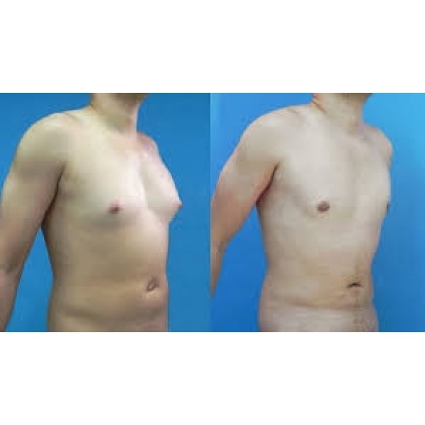 Cirurgia Mamoplastia Redutora Preço