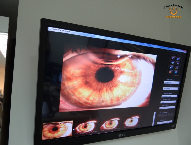 Cirurgia Ocular para Astigmatismo