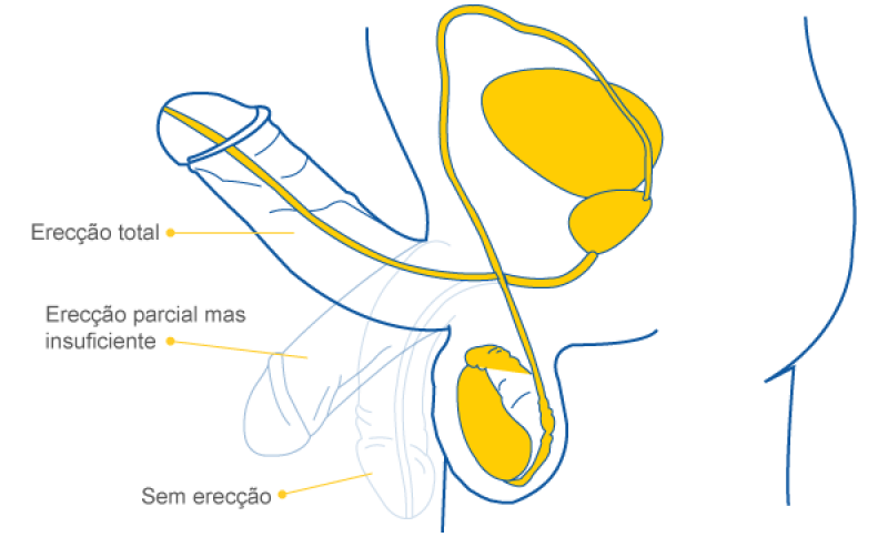 Cirurgia para Engrossamento de Pênis