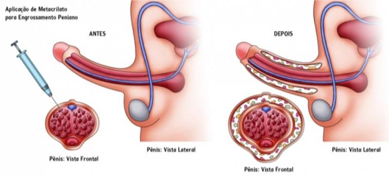 Cirurgia para Engrossar o Pênis