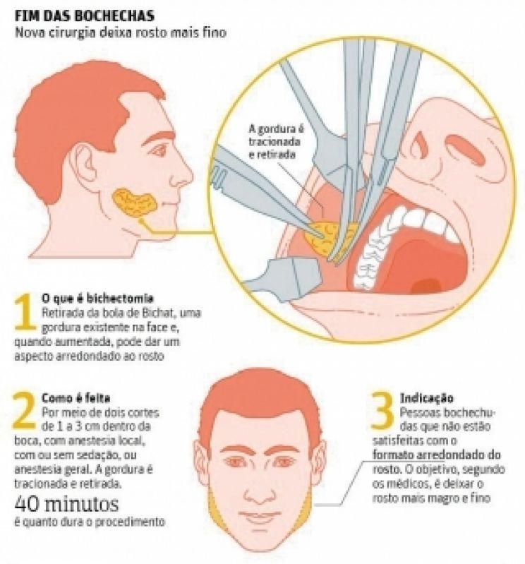 Cirurgia para Reduzir Bochechas