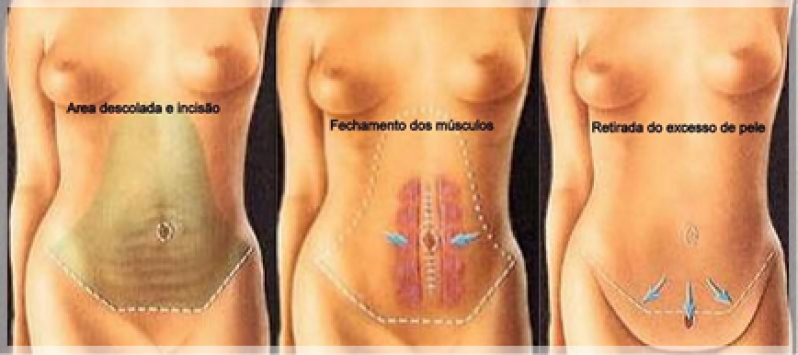 Cirurgia Plástica a Laser