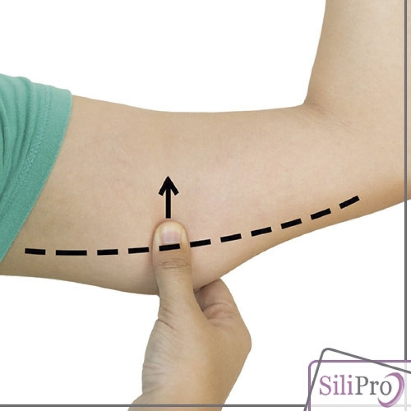 Cirurgia Plástica Braços Cicatriz