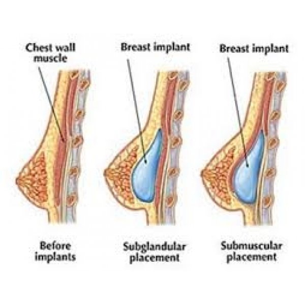 Cirurgia Plástica Mamoplastia Redutora Preço