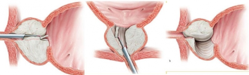 Cirurgia Urológica Minimamente Invasiva
