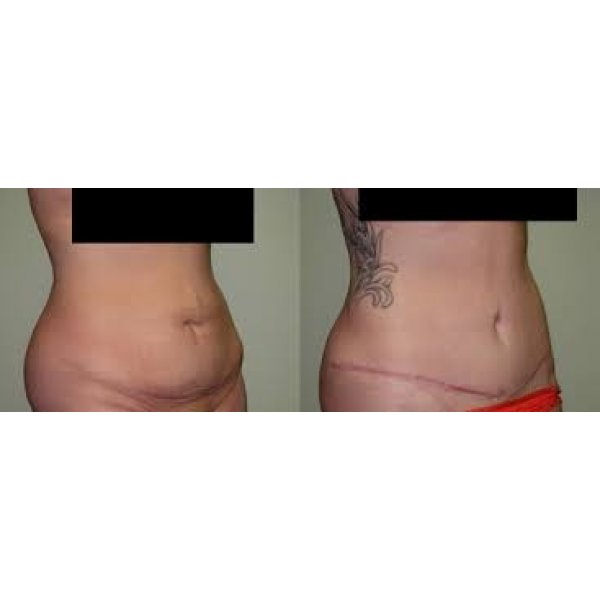 Cirurgião de Abdominoplastia