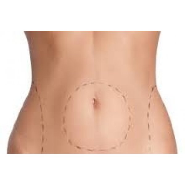 Cirurgias de Lipoaspiração em Paraíso