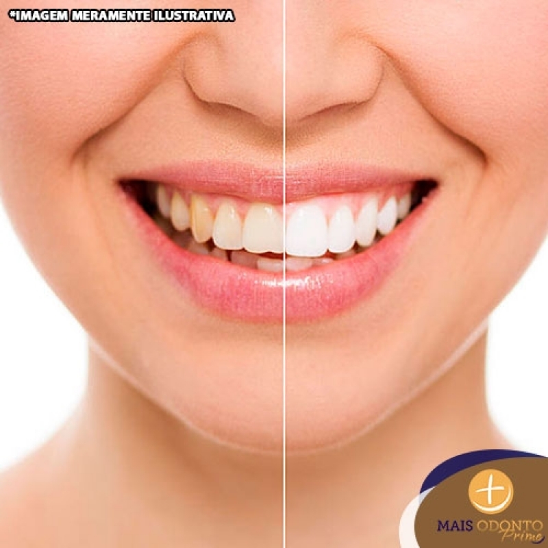 Clareamento de Dente Laser