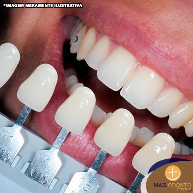 Clareamento Dental com Moldeira