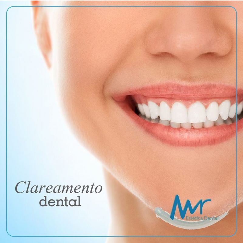 Clareamento Dental para Dentes Sensíveis