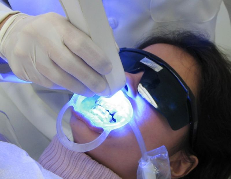 Clareamento Dentário de Consultório
