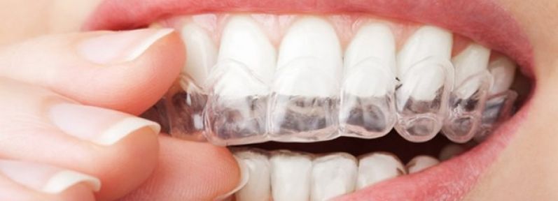Clareamento para Dentes