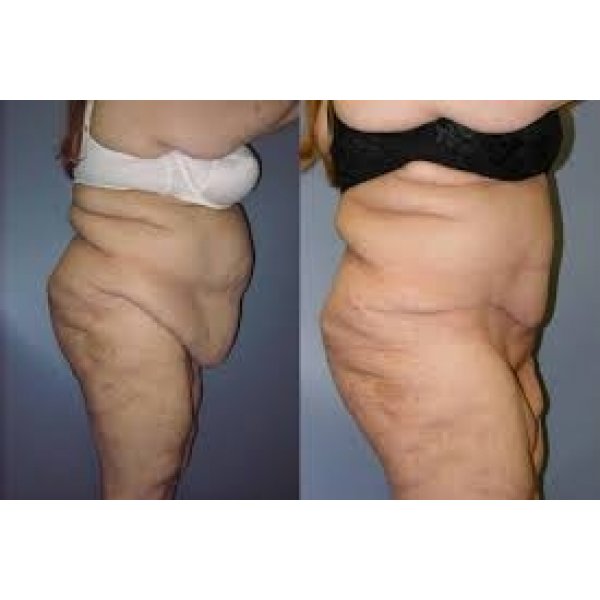 Clínica de Abdominoplastia na Avenida Paulista