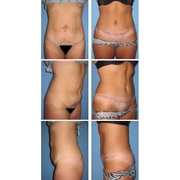 Clínica de Abdominoplastia na Rua Abílio Soares