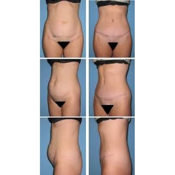 Clínica de Abdominoplastia na Zona Norte