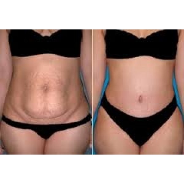 Clínica de Abdominoplastia na Zona Sul